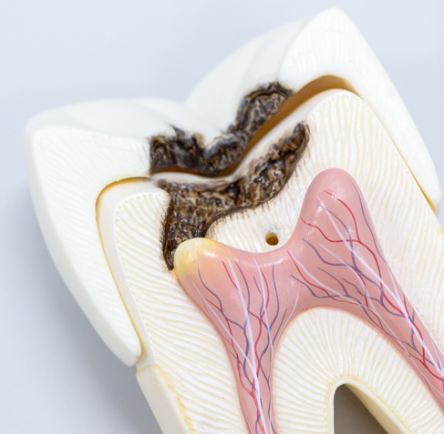 Почему болит зуб?