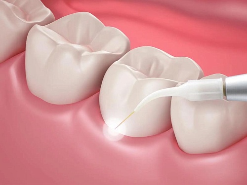 Обработка пародонтальных карманов