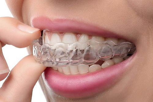 Лечения элайнерами