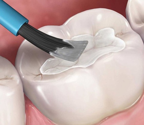 Покрытие фторпротектором FLUOCAL
