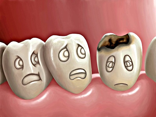 Причины кариеса дентина